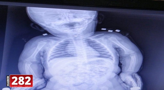 Bebeğin yuttuğu çengelli iğne yemek borusundan operasyonla çıkarıldı